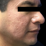 Skincare Treatment Before & After Patient #6863