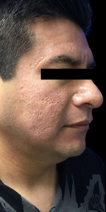 Skincare Treatment Before & After Patient #6863
