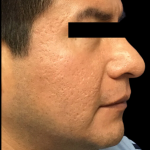 Skincare Treatment Before & After Patient #6863