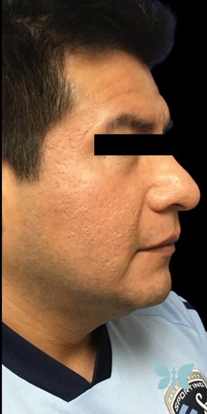 Skincare Treatment Before & After Patient #6863