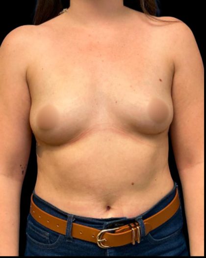 Breast Augmentation Before & After Patient #6935