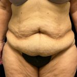 Fleur-de-lis Abdominoplasty Before & After Patient #6884