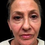 Blepharoplasty Before & After Patient #6945
