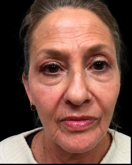 Blepharoplasty Before & After Patient #6945