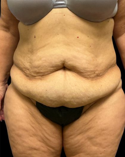 Fleur-de-lis Abdominoplasty Before & After Patient #6884