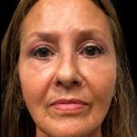 Blepharoplasty Before & After Patient #6945
