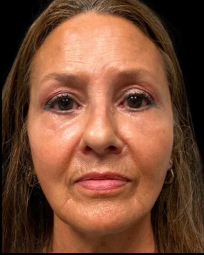 Blepharoplasty Before & After Patient #6945