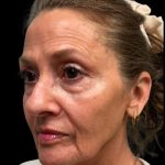 Blepharoplasty Before & After Patient #6945