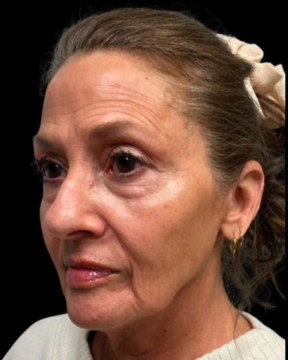 Blepharoplasty Before & After Patient #6945
