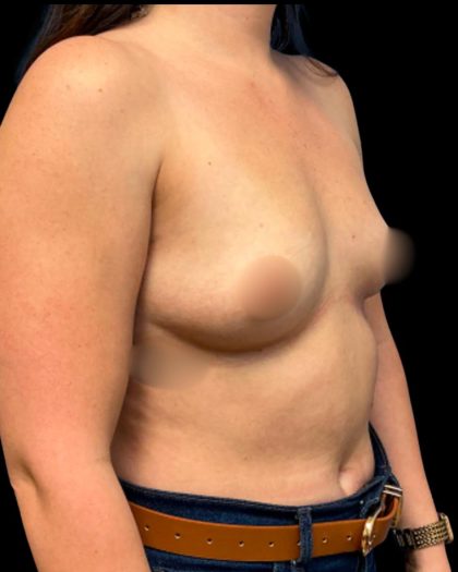 Breast Augmentation Before & After Patient #6935