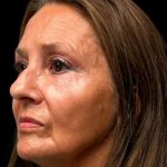 Blepharoplasty Before & After Patient #6945