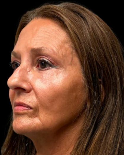 Blepharoplasty Before & After Patient #6945
