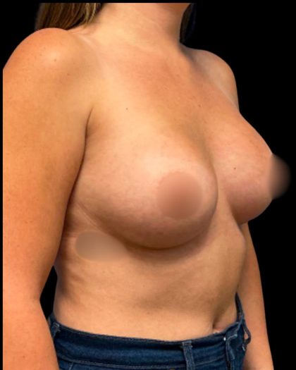Breast Augmentation Before & After Patient #6935
