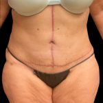 Fleur-de-lis Abdominoplasty Before & After Patient #6884