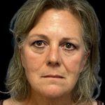 Facelift Before & After Patient #6946