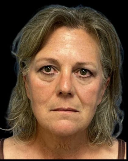 Facelift Before & After Patient #6946