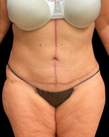 Fleur-de-lis Abdominoplasty Before & After Patient #6884