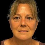 Facelift Before & After Patient #6946