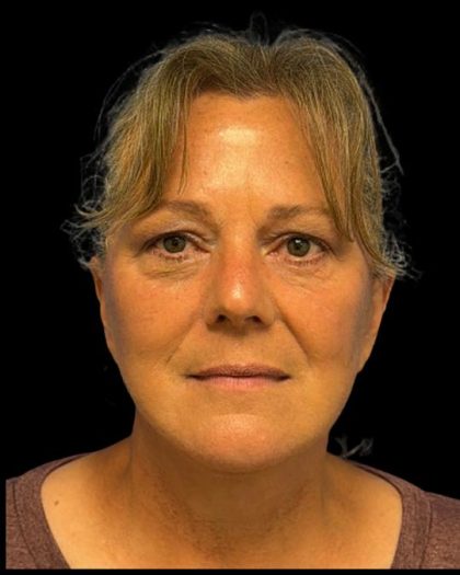 Facelift Before & After Patient #6946