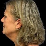 Facelift Before & After Patient #6946