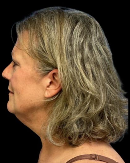 Facelift Before & After Patient #6946