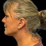 Facelift Before & After Patient #6946