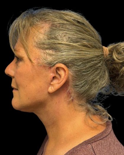Facelift Before & After Patient #6946