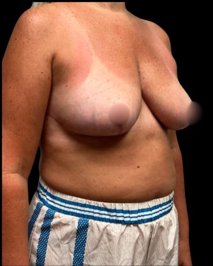 Breast Reduction Before & After Patient #6936