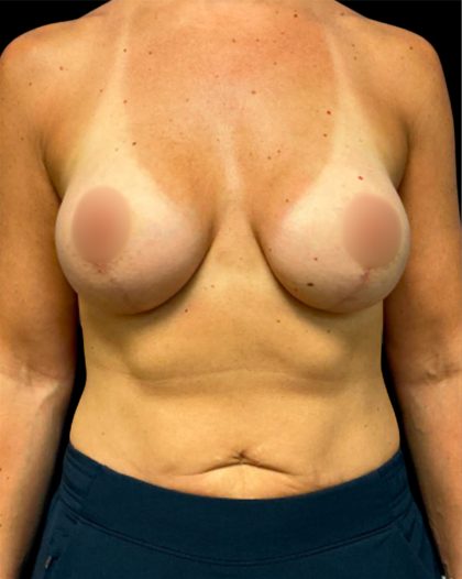 Mastopexy Augmentation Before & After Patient #6878
