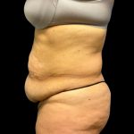 Fleur-de-lis Abdominoplasty Before & After Patient #6884