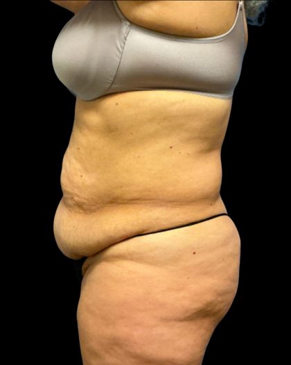 Fleur-de-lis Abdominoplasty Before & After Patient #6884