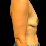 Mastopexy Augmentation Before & After Patient #6878