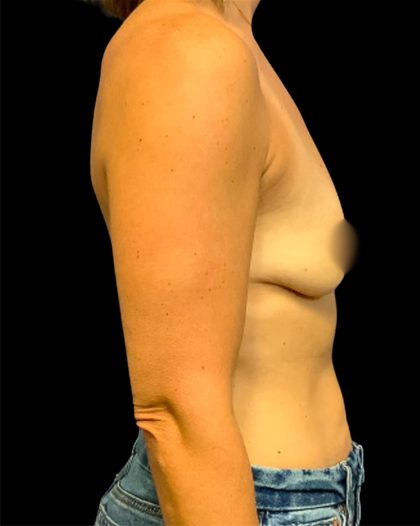 Mastopexy Augmentation Before & After Patient #6878
