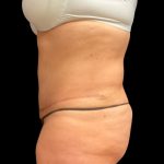 Fleur-de-lis Abdominoplasty Before & After Patient #6884