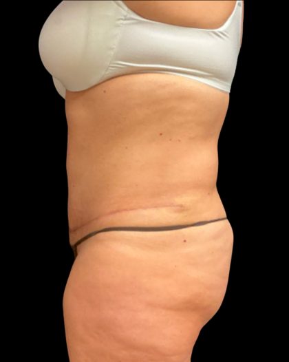 Fleur-de-lis Abdominoplasty Before & After Patient #6884