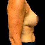 Mastopexy Augmentation Before & After Patient #6878