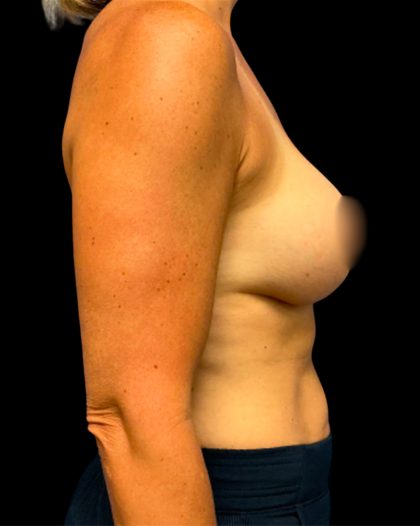 Mastopexy Augmentation Before & After Patient #6878