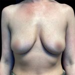 Breast Augmentation Before & After Patient #6889