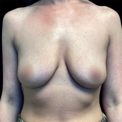 Breast Augmentation Before & After Patient #6889