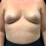Breast Augmentation Before & After Patient #6873