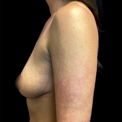 Breast Augmentation Before & After Patient #6889
