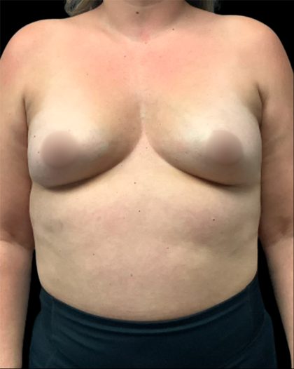 Breast Augmentation Before & After Patient #6873