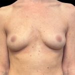 Breast Augmentation Before & After Patient #6890