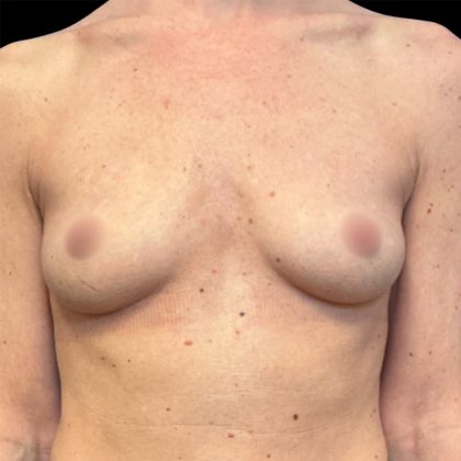 Breast Augmentation Before & After Patient #6890