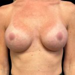 Breast Augmentation Before & After Patient #6890