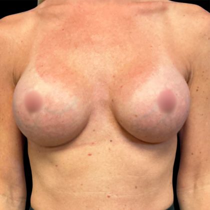 Breast Augmentation Before & After Patient #6890