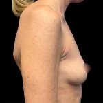 Breast Augmentation Before & After Patient #6890