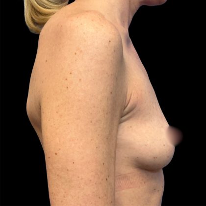 Breast Augmentation Before & After Patient #6890