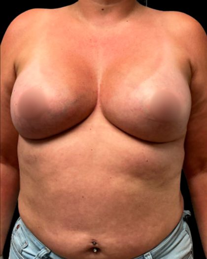 Breast Augmentation Before & After Patient #6873