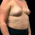Breast Augmentation Before & After Patient #6873